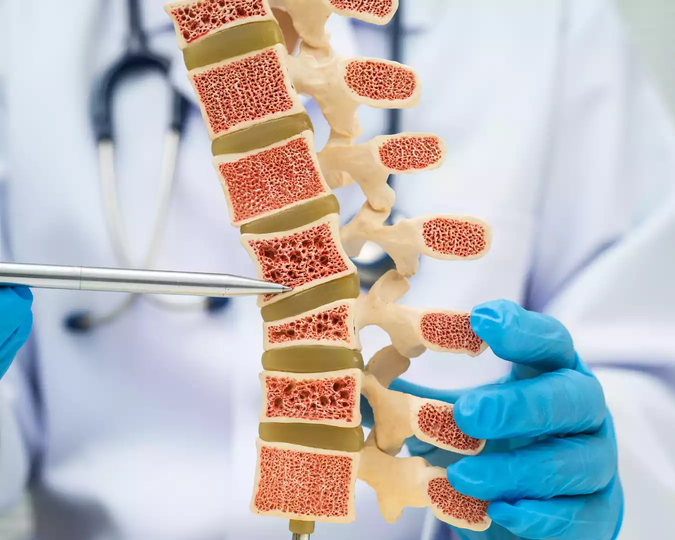 Fractura vertebral por osteoporosis