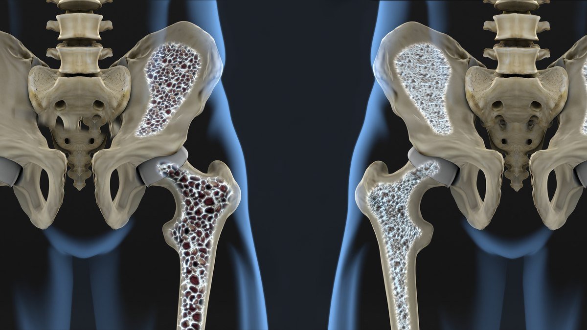 osteoporosis mediante pruebas de densidad ósea - Dr. Miguel Angel González Reyes