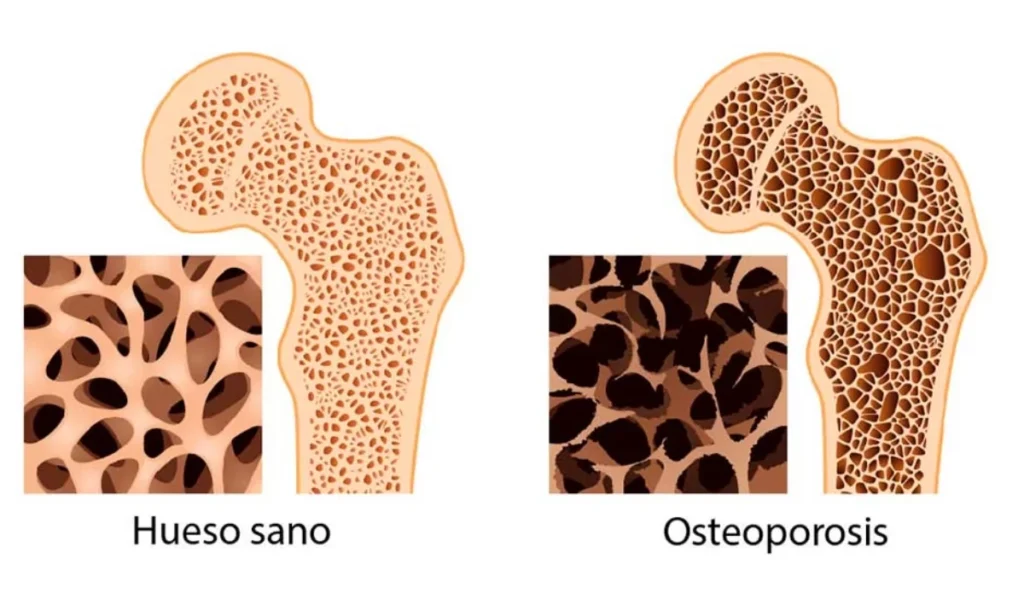 osteoporosis: mitos y verdades por el Dr. Miguel Angel González Reyes