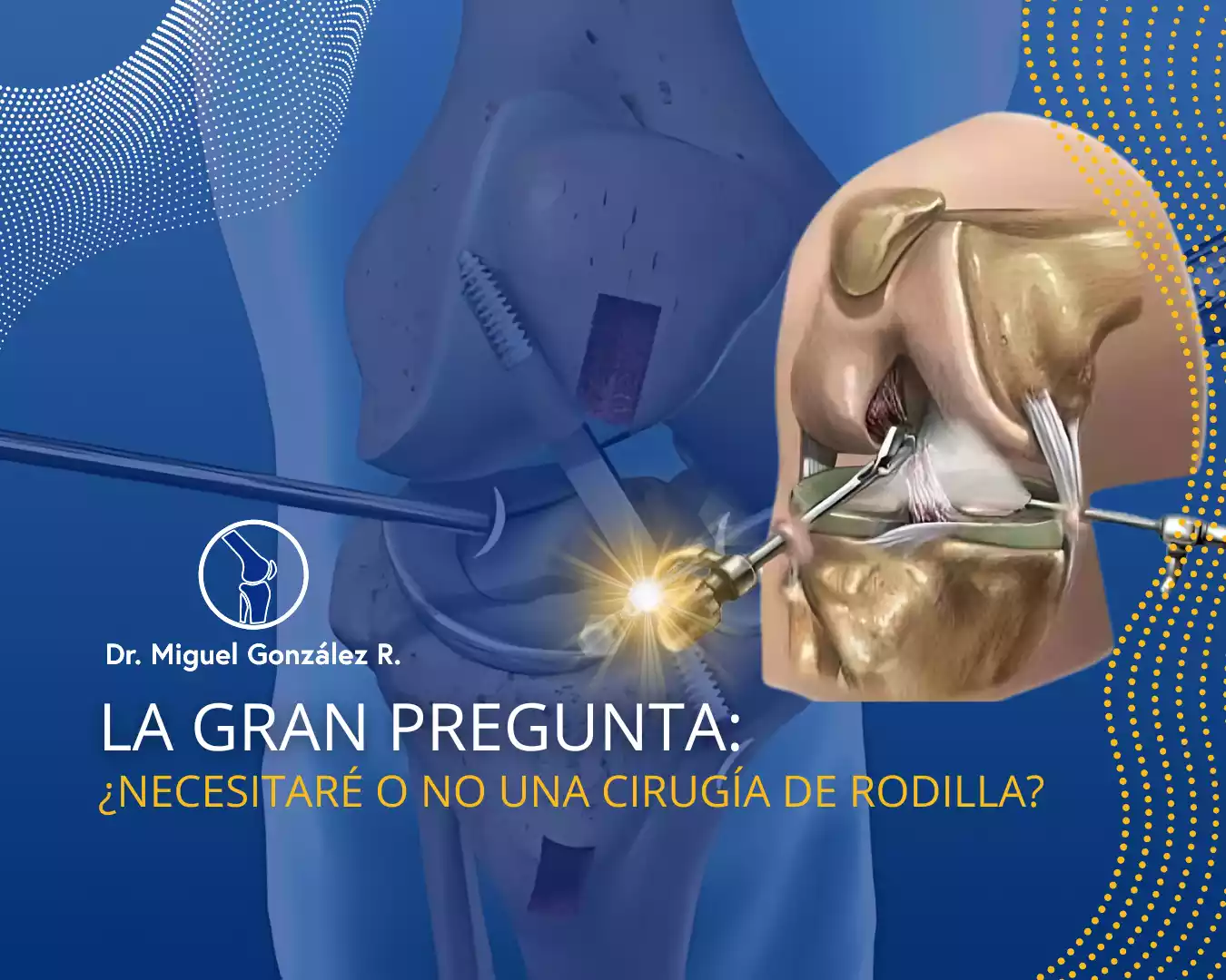 La Gran pregunta: ¿Necesitaré o no una cirugía de Rodilla? - Dr. Miguel Angel González Reyes