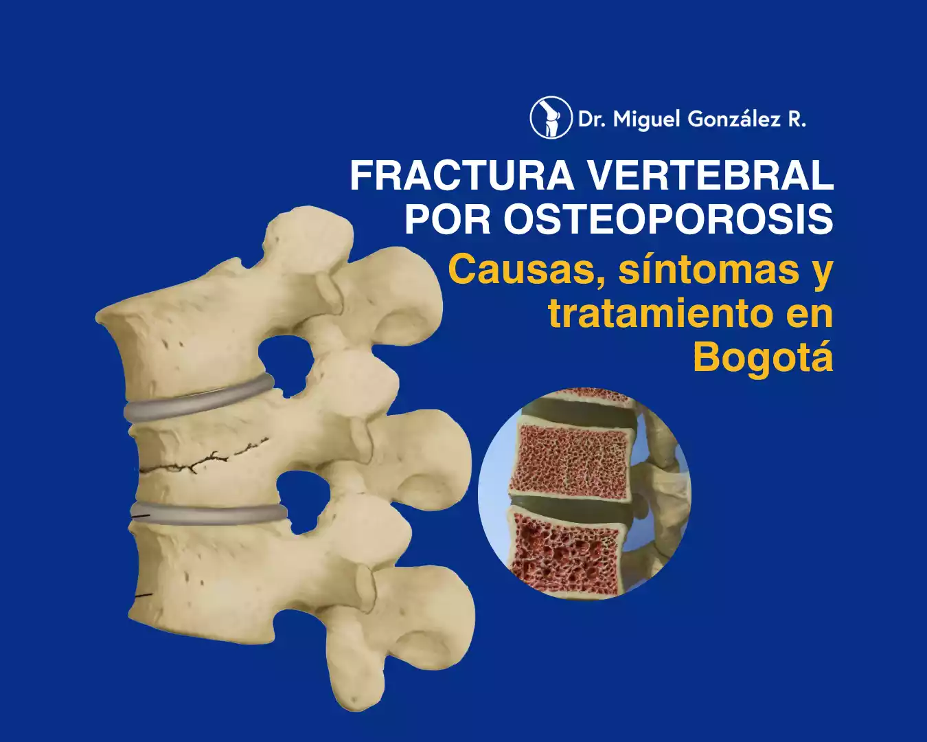 fracturas vertebrales